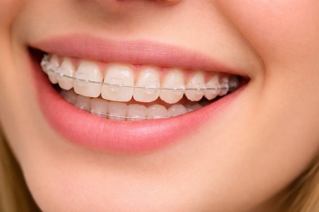 Керамические брекеты