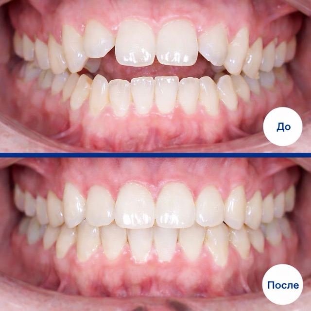 Брекеты до и после лечения – исправление прикуса и выравнивание зубов