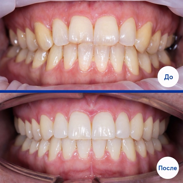 Выравнивание зубов брекетами – результат ортодонтического лечения