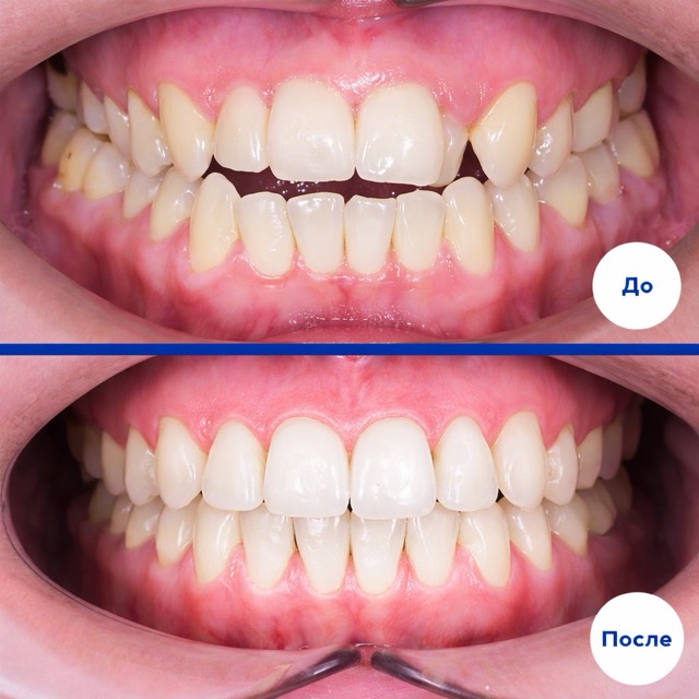 Ортодонтическое лечение брекетами – фото до и после