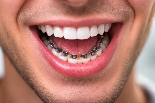 Лингвальные брекеты