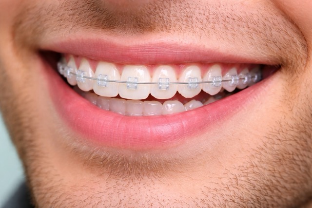 Сапфировые брекеты