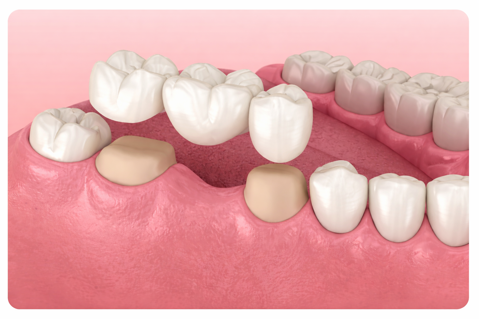 Мостовидный протез