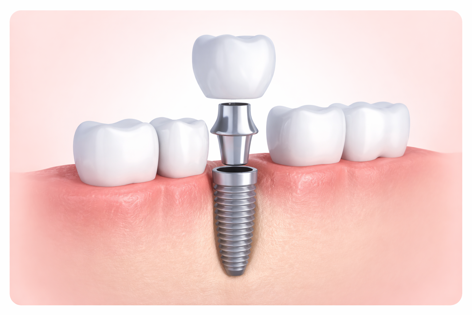 Единичная коронка на имплантате