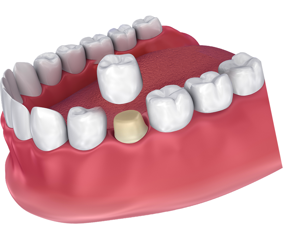 Зубная коронка. Зуб с короной. Ортопедическая коронка.