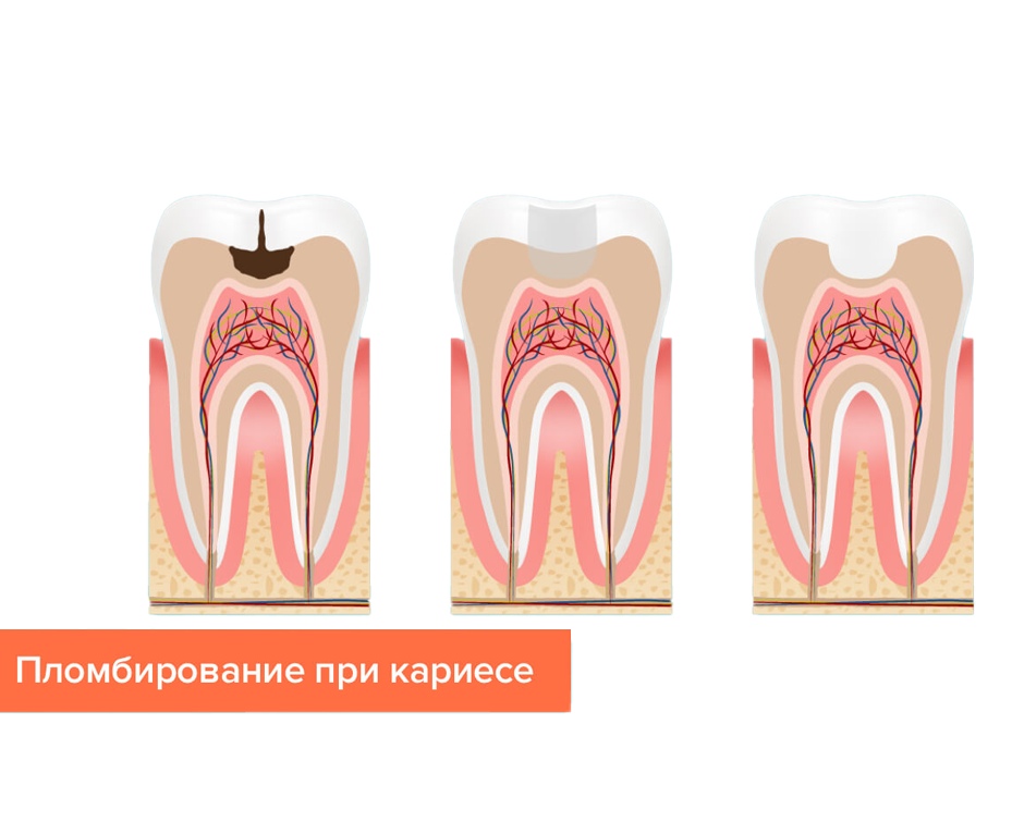 Пломбирование зубов