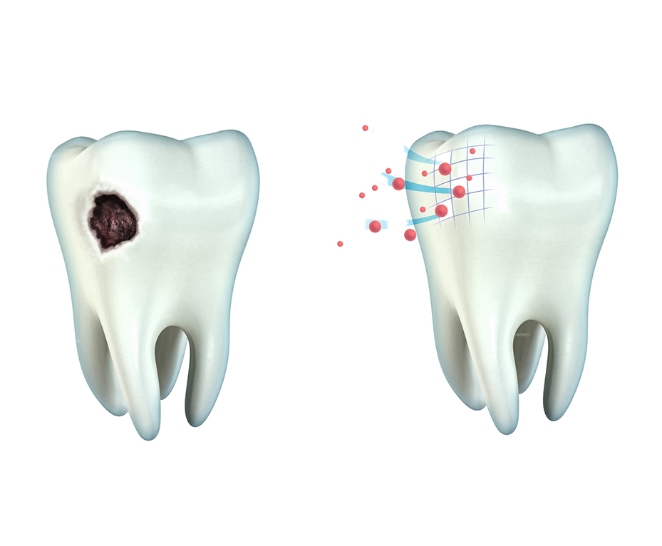Реминерализация зубов