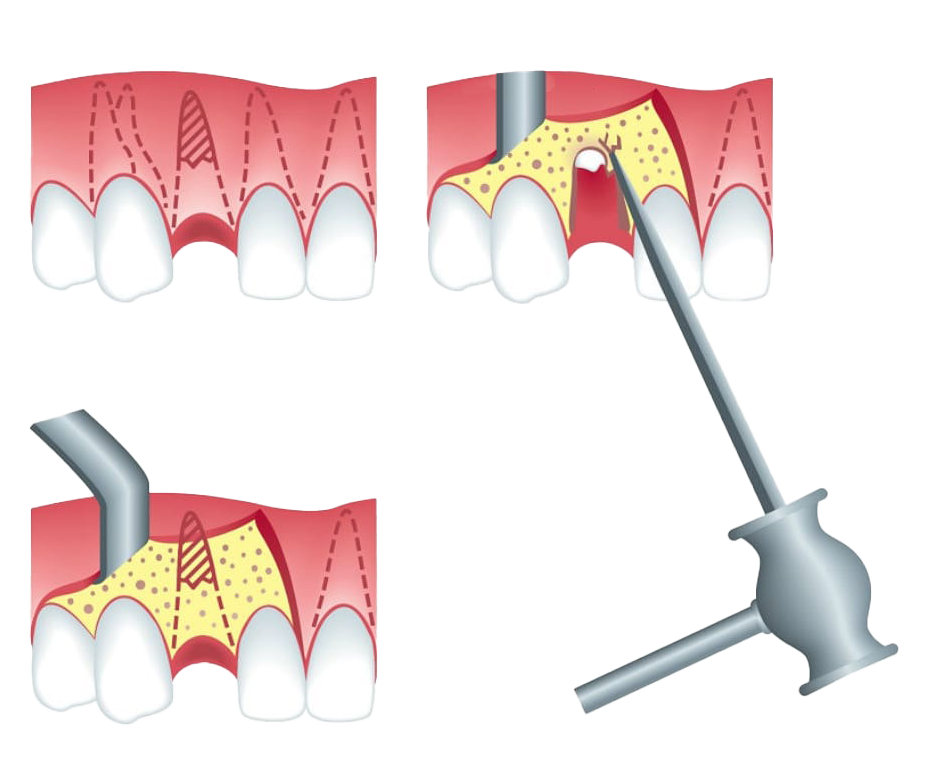Удаление фрагмента зуба