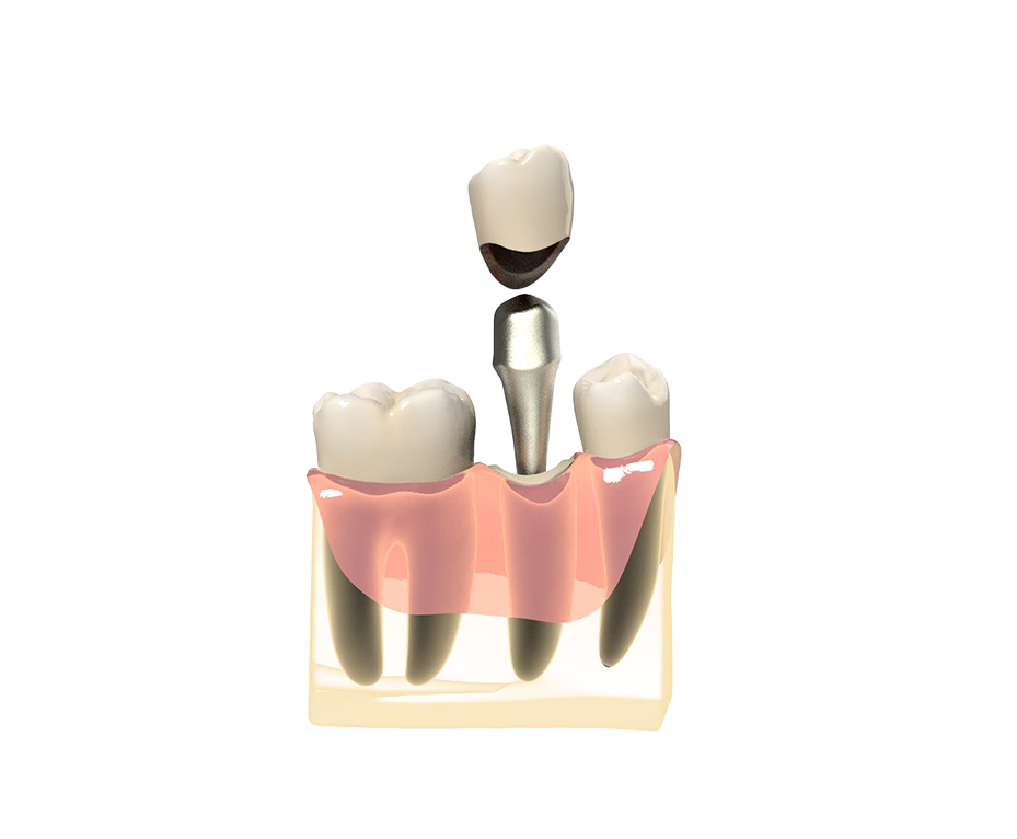 Культевая вкладка под коронку