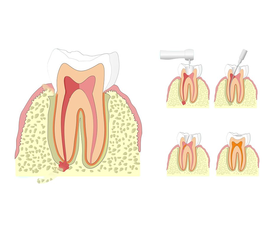 Лечение гранумёлы