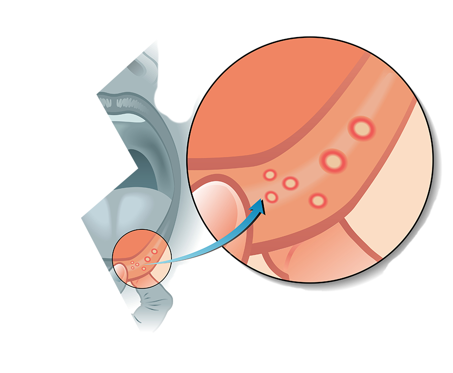 Лечение стоматита Лечение стоматита
