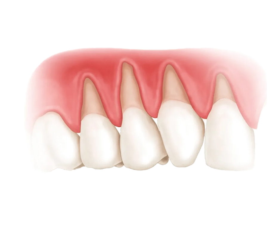Клиновидный дефект зубов