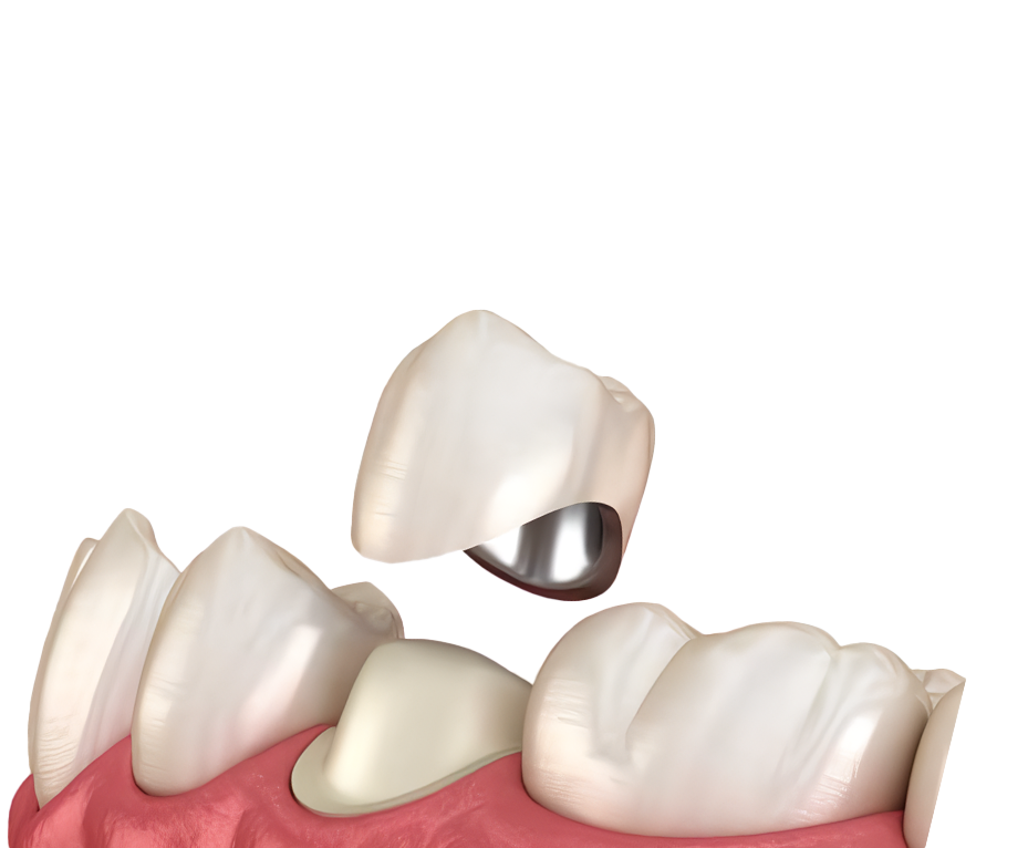 Металлокерамические коронки